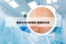 腳癬分為幾種類型 腳癬的分類
