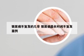 銀屑病不復發(fā)的幾率 銀屑病最長時間不復發(fā)案例