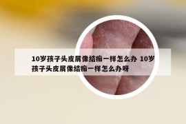 10歲孩子頭皮屑像結(jié)痂一樣怎么辦 10歲孩子頭皮屑像結(jié)痂一樣怎么辦呀