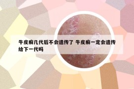 牛皮癬幾代后不會(huì)遺傳了 牛皮癬一定會(huì)遺傳給下一代嗎