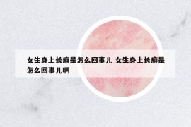 女生身上長癬是怎么回事兒 女生身上長癬是怎么回事兒啊