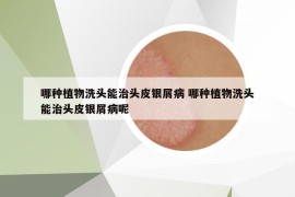 哪種植物洗頭能治頭皮銀屑病 哪種植物洗頭能治頭皮銀屑病呢