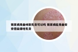 銀屑病用曲咪新乳膏可以嗎 銀屑病能用曲安奈德益康唑乳膏