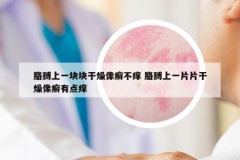 胳膊上一塊塊干燥像癬不癢 胳膊上一片片干燥像癬有點(diǎn)癢