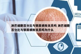 淋巴細(xì)胞百分比與銀屑病有關(guān)系嗎 淋巴細(xì)胞百分比與銀屑病有關(guān)系嗎為什么