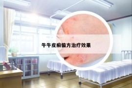 牛牛皮癬偏方治療效果