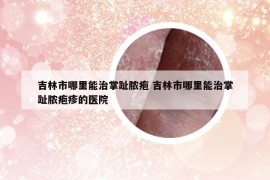 吉林市哪里能治掌趾膿皰 吉林市哪里能治掌趾膿皰疹的醫(yī)院