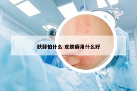 膚蘚怕什么 皮膚癬用什么好