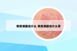 銀屑病最怕什么 銀屑病最怕什么草