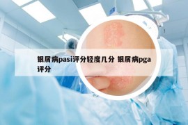 銀屑病pasi評(píng)分輕度幾分 銀屑病pga評(píng)分