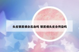 頭皮銀屑病會(huì)出血嗎 銀屑病頭皮會(huì)傳染嗎