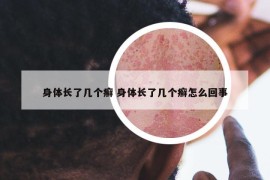身體長了幾個(gè)癬 身體長了幾個(gè)癬怎么回事