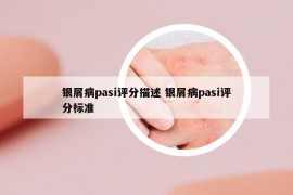 銀屑病pasi評分描述 銀屑病pasi評分標(biāo)準(zhǔn)