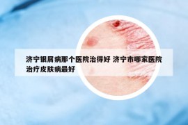 濟寧銀屑病那個醫(yī)院治得好 濟寧市哪家醫(yī)院治療皮膚病最好