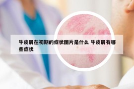 牛皮屑在初期的癥狀圖片是什么 牛皮屑有哪些癥狀