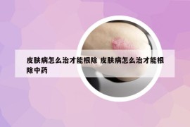 皮膚病怎么治才能根除 皮膚病怎么治才能根除中藥