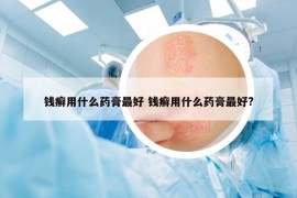錢癬用什么藥膏最好 錢癬用什么藥膏最好?