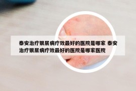 泰安治療銀屑病療效最好的醫(yī)院是哪家 泰安治療銀屑病療效最好的醫(yī)院是哪家醫(yī)院