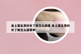 身上莫名其妙長了癬怎么回事 身上莫名其妙長了癬怎么回事啊