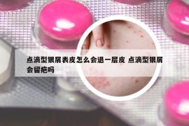 點滴型銀屑表皮怎么會退一層皮 點滴型銀屑會留疤嗎
