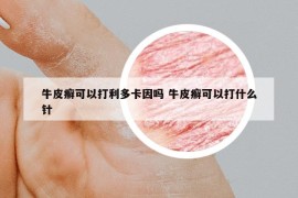 牛皮癬可以打利多卡因嗎 牛皮癬可以打什么針