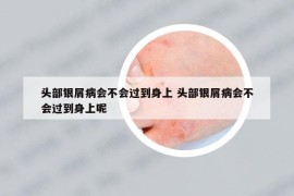 頭部銀屑病會不會過到身上 頭部銀屑病會不會過到身上呢