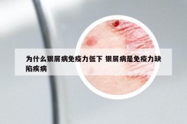 為什么銀屑病免疫力低下 銀屑病是免疫力缺陷疾病