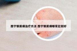 西寧銀屑病治療方法 西寧銀屑病哪家比較好