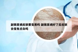 副銀屑病皮膚要變黑嗎 副銀屑病好了后皮膚會變有點白嗎