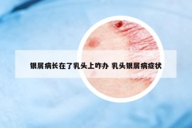 銀屑病長(zhǎng)在了乳頭上咋辦 乳頭銀屑病癥狀
