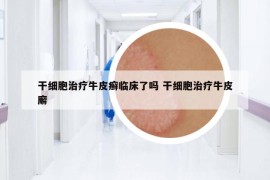 干細胞治療牛皮癬臨床了嗎 干細胞治療牛皮廨