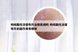 枸櫞酸托法替布片治銀屑病嗎 枸櫞酸托法替布片的副作用有哪些
