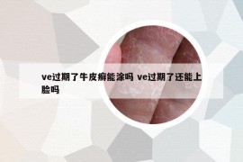 ve過(guò)期了牛皮癬能涂嗎 ve過(guò)期了還能上臉嗎