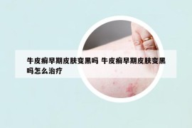 牛皮癬早期皮膚變黑嗎 牛皮癬早期皮膚變黑嗎怎么治療