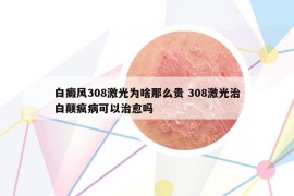 白癜風(fēng)308激光為啥那么貴 308激光治白顛瘋病可以治愈嗎