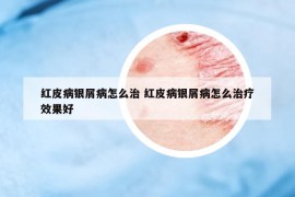 紅皮病銀屑病怎么治 紅皮病銀屑病怎么治療效果好