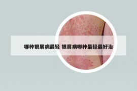 哪種銀屑病最輕 銀屑病哪種最輕最好治