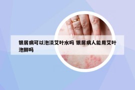 銀屑病可以泡淡艾葉水嗎 銀屑病人能用艾葉泡腳嗎