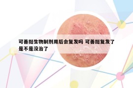 可善挺生物制劑用后會(huì)復(fù)發(fā)嗎 可善挺復(fù)發(fā)了是不是沒治了