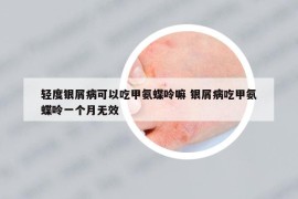 輕度銀屑病可以吃甲氨蝶呤嘛 銀屑病吃甲氨蝶呤一個(gè)月無(wú)效