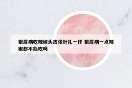 銀屑病吃辣椒頭皮像針扎一樣 銀屑病一點(diǎn)辣椒都不能吃嗎