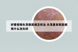 好看視頻頭發(fā)銀屑病怎樣治 頭發(fā)里有銀屑病用什么洗頭好