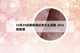 10月29日銀屑病日有什么進展 2021銀屑病