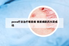 puva療法治療銀屑病 銀屑病新藥大獲成功