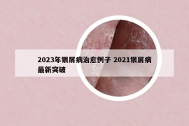 2023年銀屑病治愈例子 2021銀屑病最新突破