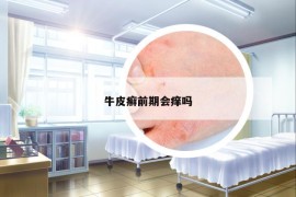 牛皮癬前期會癢嗎