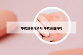 牛皮顯會(huì)傳染嗎 牛皮會(huì)遺傳嗎