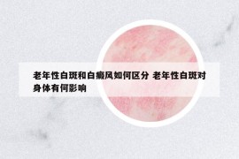 老年性白斑和白癜風(fēng)如何區(qū)分 老年性白斑對(duì)身體有何影響