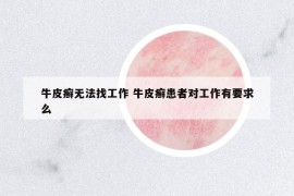 牛皮癬無(wú)法找工作 牛皮癬患者對(duì)工作有要求么