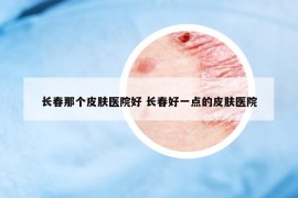 長春那個皮膚醫(yī)院好 長春好一點的皮膚醫(yī)院